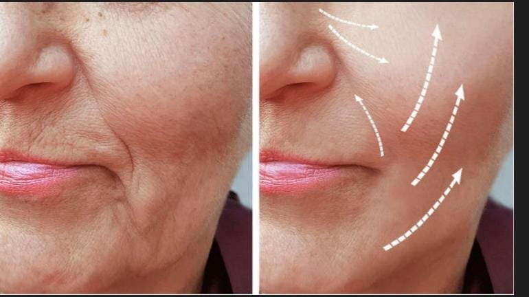 Facial de lifting