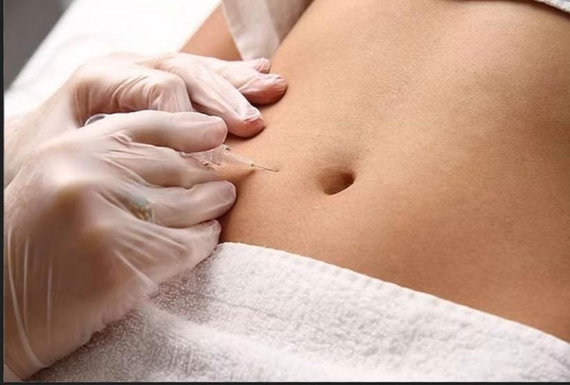 Carboxiterapia cuerpo