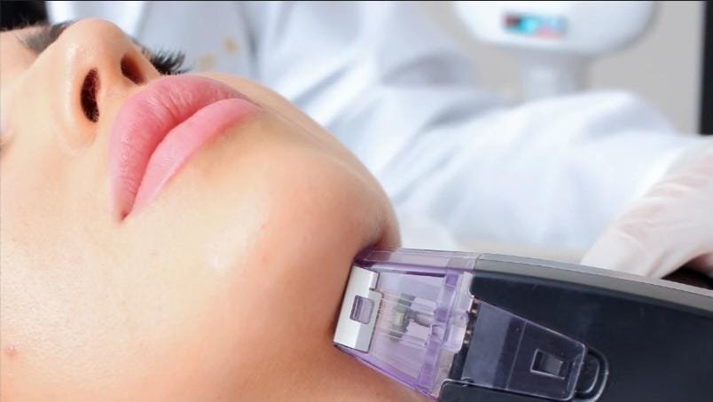 Radiofrecuencia fraccionada